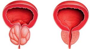 the difference is that the patient and healthy prostate