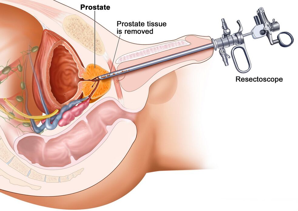 Collection of prostate tissue for the correct diagnosis of prostatitis
